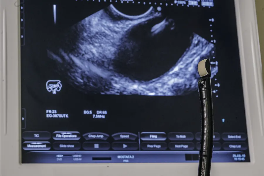 An ultrasound image on the monitor