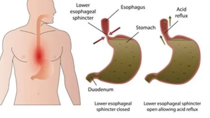 Diagram of the esophagus and stomach, with the lower esophageal sphincter closed and open