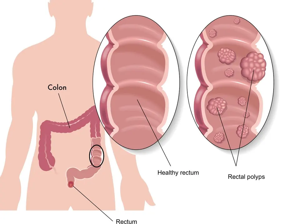 Diagram of the colon and rectum, with a healthy rectum and a rectum with polyps