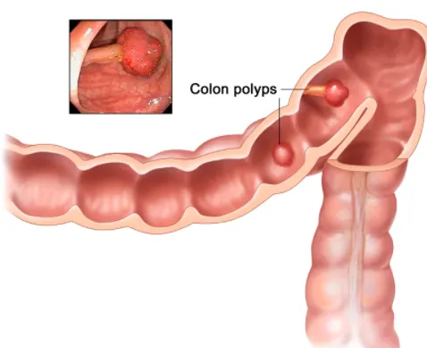 Diagram of polyps on the inside of the colon