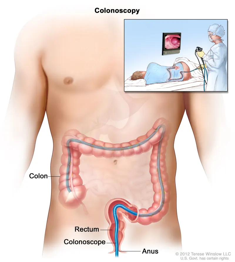 Diagram of a colonoscopy, showing the colonoscope in the colon
