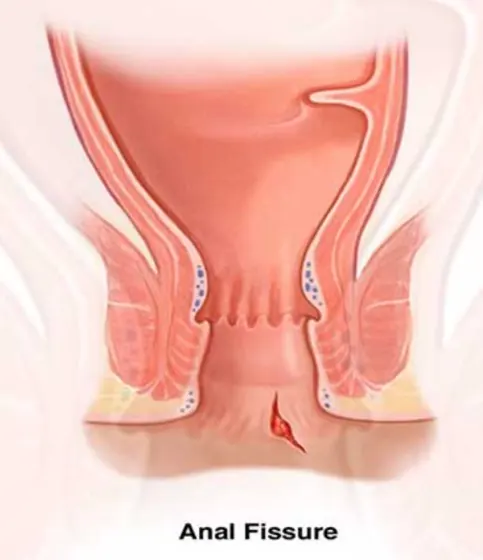 Diagram of an anal fissure
