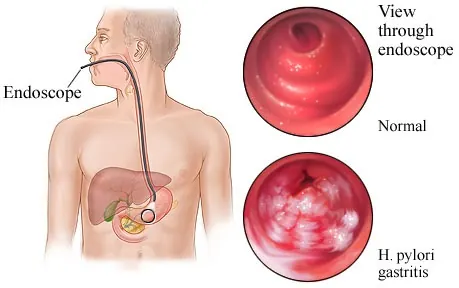 Diagram of an endoscope in the stomach, with a normal view and a view of H. pylori gastritis