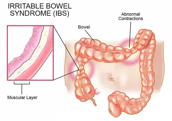 Diagram of the bowel in irritable bowel syndrome, showing abnormal contractions
