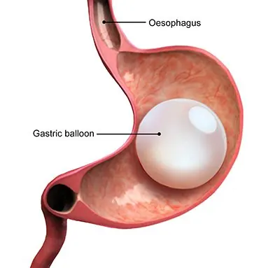 Diagram of a gastric balloon in the stomach