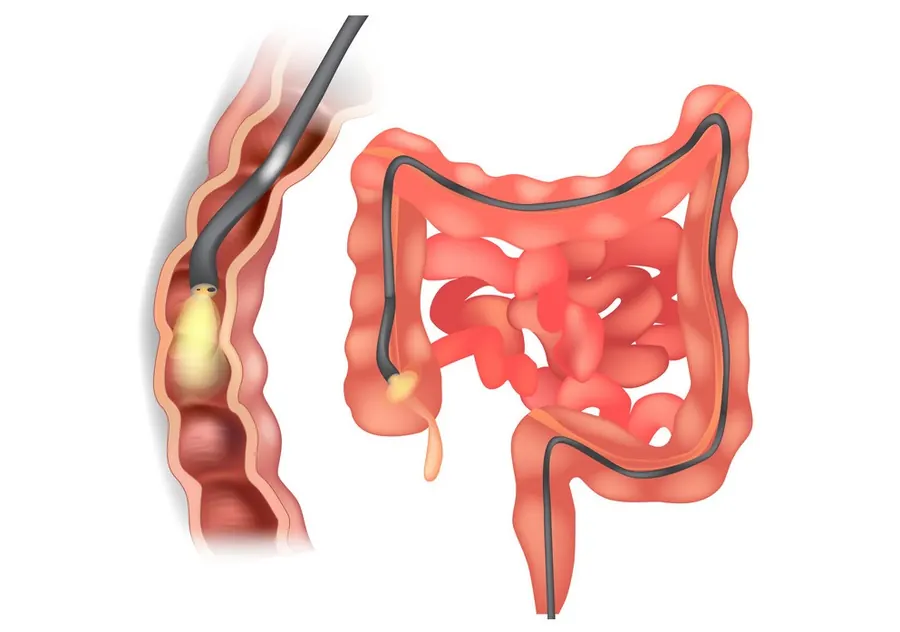 Illustration of a colonoscope in the large intestine