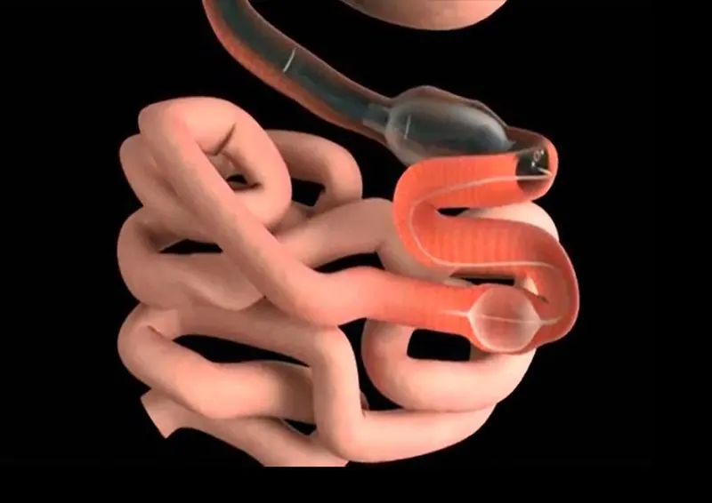 Illustration of a balloon enteroscope in the small intestine