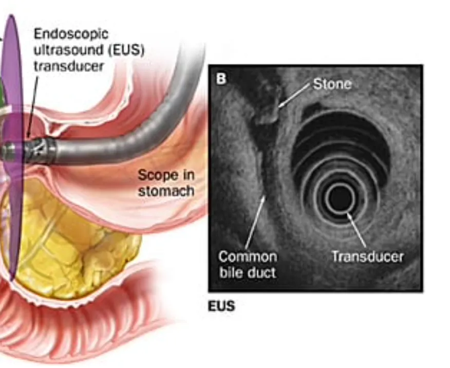Illustration of an endoscopic ultrasound probe in the stomach