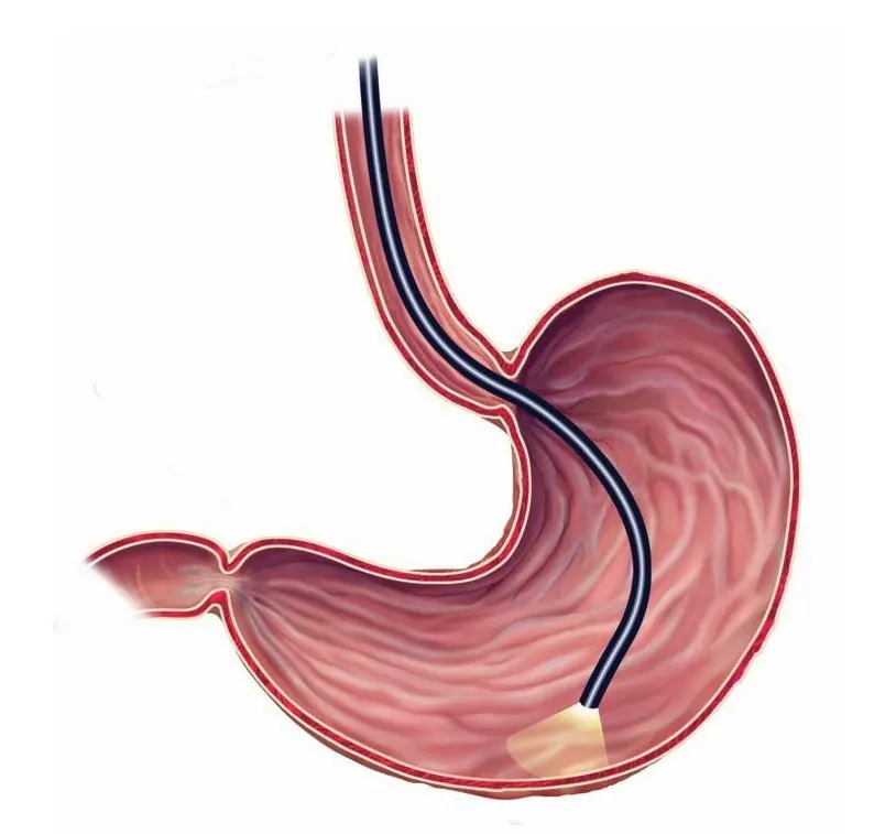 Illustration of an endoscope passing through the esophagus into the stomach